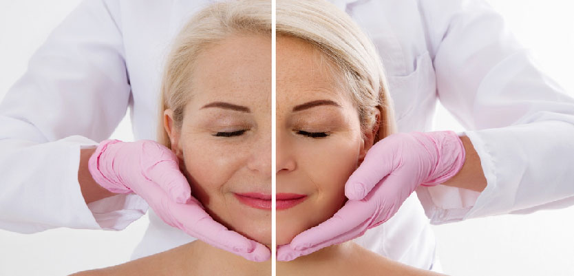 Wrinkle Reduction